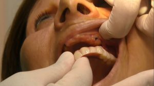 Implantologie zygomatique - Implants zygomatiques - Implants dentaires zygomatiques